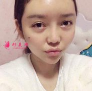 北京純脂整形醫(yī)院做了自體脂肪面部填充術(shù)后兩個月對比圖