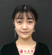 重慶軍科整形醫(yī)院做雙眼皮分享案例，看看29天了前后對(duì)比變化大嗎