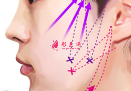 臉部埋線(xiàn)提升后吃東西有影響嗎
