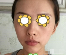 北京純脂整形醫(yī)院做全臉填充多少錢？附真實案例~