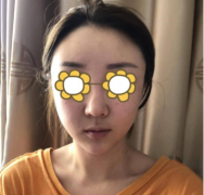 成都友誼李發(fā)展面部脂肪填充怎么樣？術(shù)后真實效果反饋~