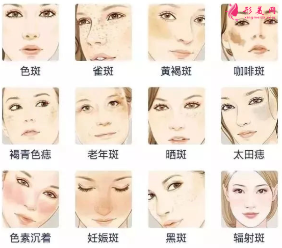 激光祛斑會(huì)有疤痕嗎