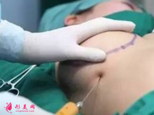 自體脂肪隆胸好么