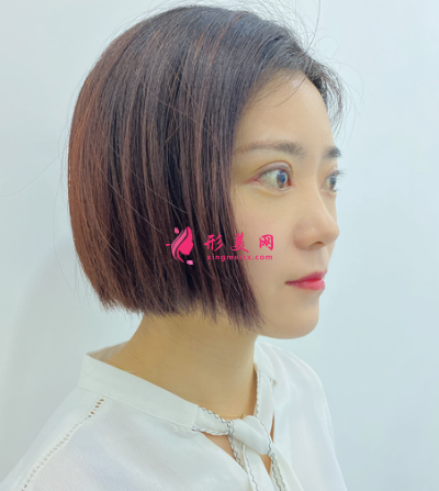 葉子整形汪環(huán)做雙眼皮