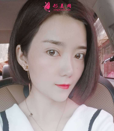 葉子整形汪環(huán)做雙眼皮