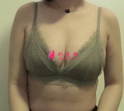 王志強院長為我做的自體脂肪隆胸手術(shù)后25天·