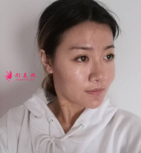 找成都軍建醫(yī)院的呂婧做自體脂肪豐面頰手術(shù)前