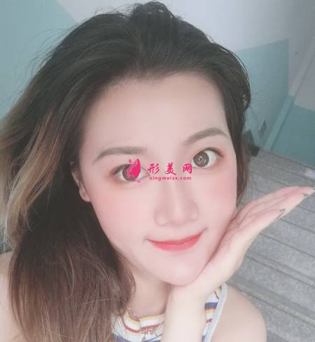 找成都軍建醫(yī)院的呂婧做自體脂肪豐面頰手術(shù)后1個(gè)月