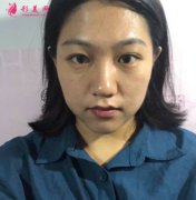 親身體驗成都軍建醫(yī)院膨體假體隆鼻后，才知道成都哪家隆鼻好