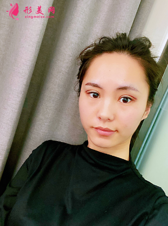 成都美綻美整形美容醫(yī)院陳宇做的眼綜合