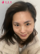 成都美綻美整形美容醫(yī)院做眼綜合，案例|價(jià)格分享給大家