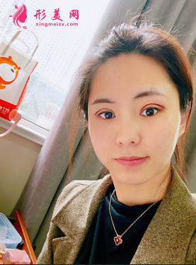 成都美綻美整形美容醫(yī)院陳宇做的眼綜合