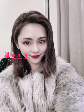 成都美綻美整形美容醫(yī)院陳宇做的眼綜合