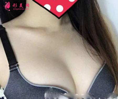 找成都圣丹福找張雪峰做了曼托275CC假體隆胸手術(shù)后30天