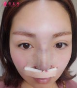 本人找成都圣丹福做了自體肋軟骨隆鼻后，鼻子好看挺拔了