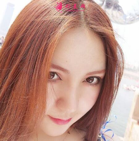 找成都圣丹福鄧兵做了自體肋軟骨隆鼻手術(shù)后17天