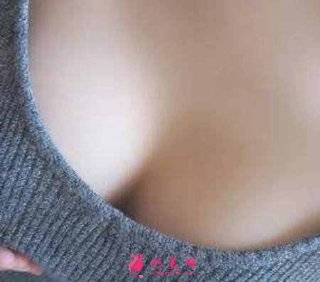 找成都友誼找黃國強(qiáng)做了自體脂肪隆胸手術(shù)后15天
