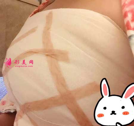 找重慶華美做找陳德法做假體隆胸手術(shù)后