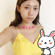 在重慶華美整形醫(yī)院做假體隆胸手術(shù)，100天恢復(fù)日記分享
