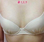 重慶華美楊麗萍給我做的自體脂肪隆胸，效果太贊了~