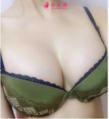 重慶華美楊麗萍給我做的自體脂肪隆胸手術(shù)后30天