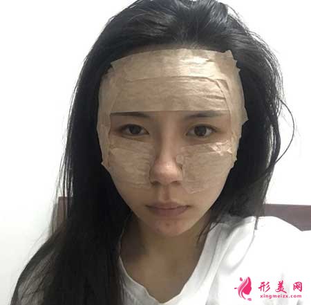 自體脂肪面部填充手術后7天