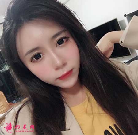 自體脂肪面部填充手術后90天