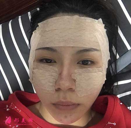 自體脂肪面部填充手術后