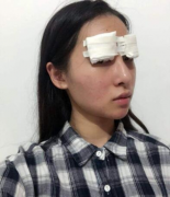 開眼角前后對比照片圖變化明顯|這些小伙伴可以看看~