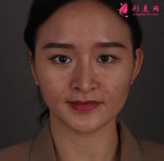 重慶錦美整形雙眼皮修復(fù)1-90天恢復(fù)過(guò)程詳解+醫(yī)院簡(jiǎn)要介紹一覽