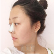 上海整形醫(yī)院耳軟骨墊鼻尖失敗照片|隆鼻修復(fù)手術(shù)案例再一次重生~