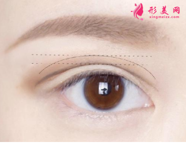 雙眼皮整形術(shù)后如何護(hù)理