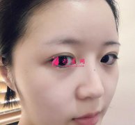 北京彤美醫(yī)療美容醫(yī)院切開雙眼皮術(shù)后兩個月效果圖分享