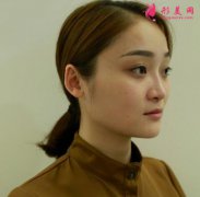 上海伯思立整形醫(yī)院隆鼻怎么樣？案例效果分享