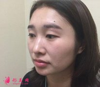 北京悅?cè)徽窝劬C合+鼻綜合術(shù)后2個月效果圖分享
