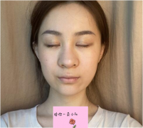 北京八大處范飛醫(yī)生隆鼻怎么樣？真實(shí)案例一覽~
