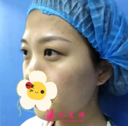佛山美萊整形醫(yī)院做的雙眼皮修復(fù)手術(shù)怎么樣？