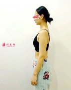 北京純脂整形醫(yī)院做豐胸整形，讓我找回了自信