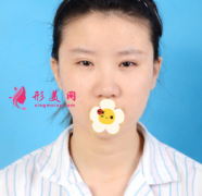 上海美聯(lián)臣整形醫(yī)院眼綜合+鼻綜合案例分享 開啟精彩人生