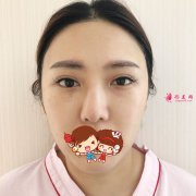 北京煤炭總醫(yī)院整形歪鼻修復(fù)案例，歪鼻洗碗妹到精致美女的逆襲