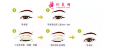全切雙眼皮感染的表現(xiàn)有哪些？術(shù)后護理怎么做