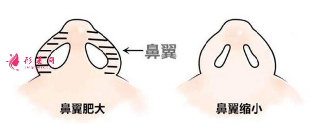 鼻翼縮小整形術(shù)