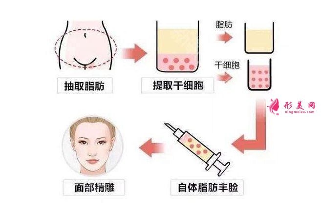 自體脂肪填充淚溝