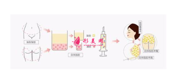 自體脂肪填充淚溝