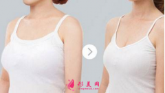 巨乳縮小術后多久能恢復？4大優(yōu)勢讓你不再猶豫
