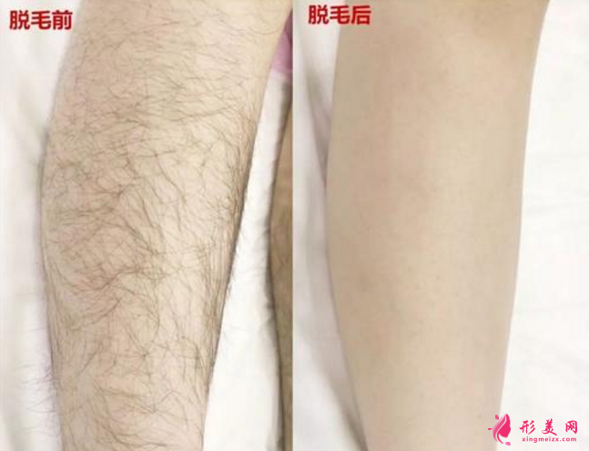 如何能永久脫毛