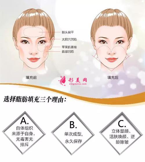 自體脂肪面部填充術(shù)前準備