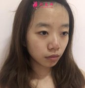 杭州維多利亞醫(yī)療美容醫(yī)院雙眼皮效果怎么樣？親述恢復(fù)日記