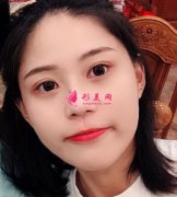 上海華美整形醫(yī)院做雙眼皮好嗎？分享手術真實恢復經(jīng)驗和效果圖