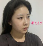 成都軍大醫(yī)院做雙眼皮一個(gè)月了，看前后對比效果圖一覽